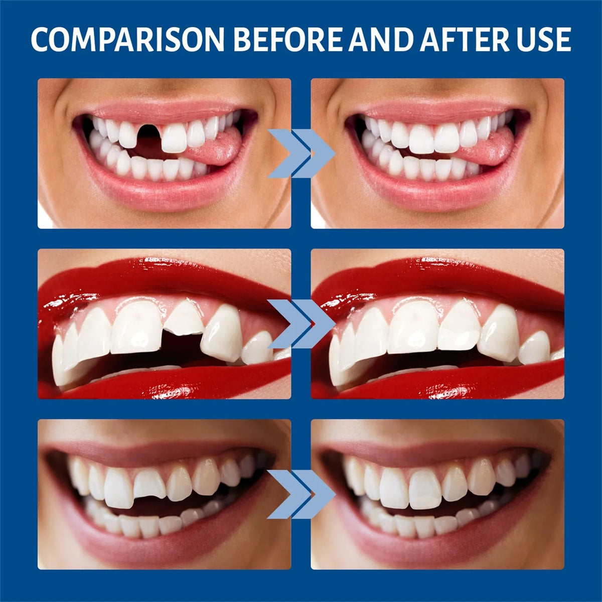 Comparison showing before and after use of a temporary tooth repair kit for gaps and fillings.